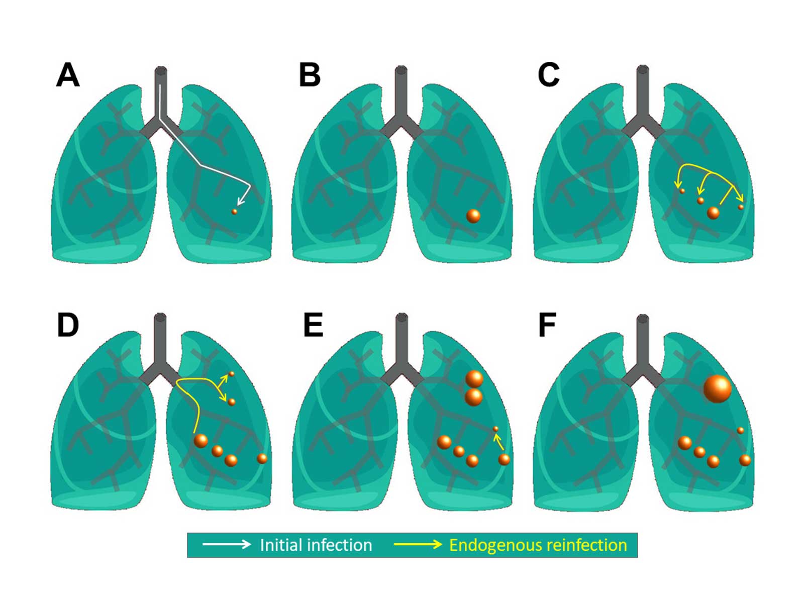 Virtual lungs to understand the dynamics of tuberculosis lesions within the lungs